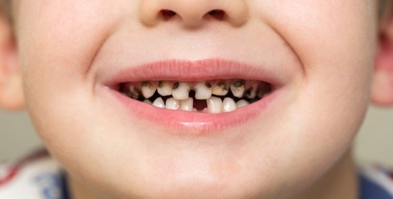 Demir Şurubu ve Antibiyotikler Dişi Çürütür mü?