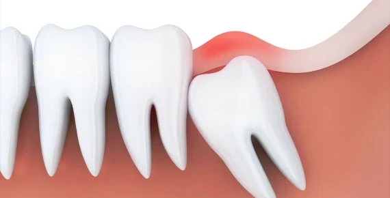 Gömülü 20’lik Diş Çekimi Nedir? Ankara 2024