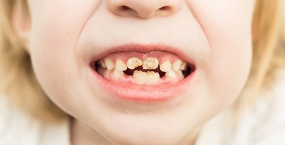 Çocuklardaki Siyah Diş Lekelerin Nedeni Nedir? 