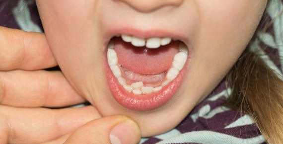 Süt Dişi Düşmeden Gelen Kalıcı Dişler Sorun Yaratır mı? 