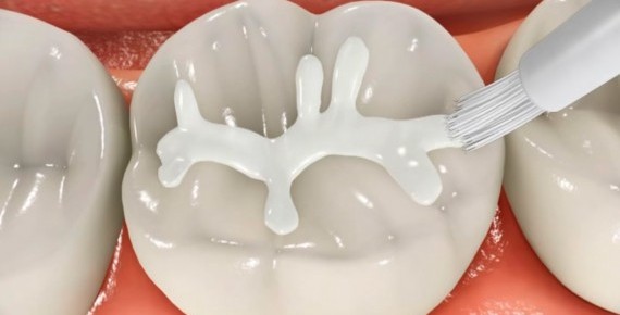 Fissür Örtücü Nedir?