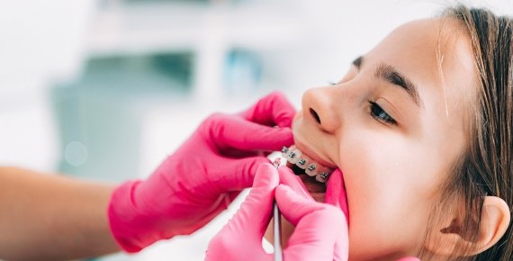 Çocuklarda Çarpık Diş Tedavisi Ankara 2024